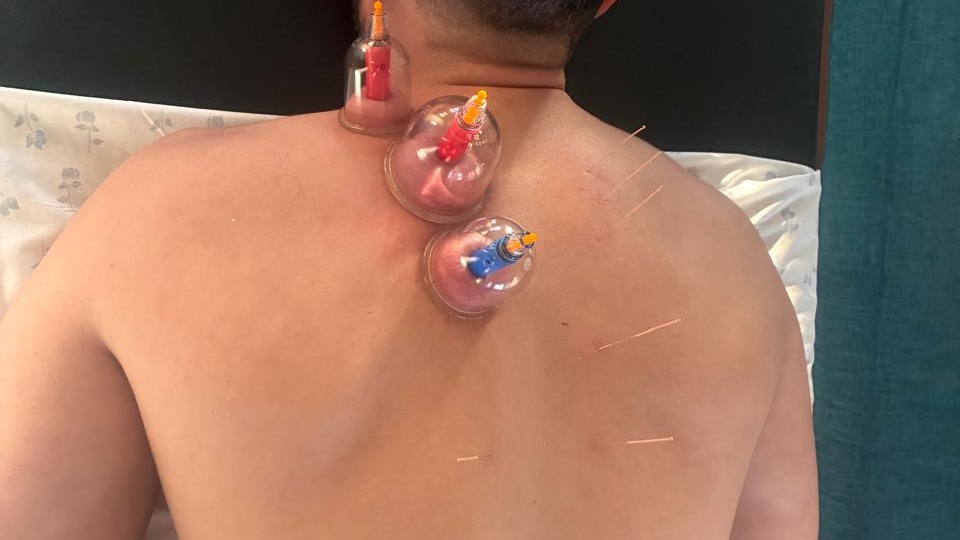 Tratamiento de acupuntura y ventosas