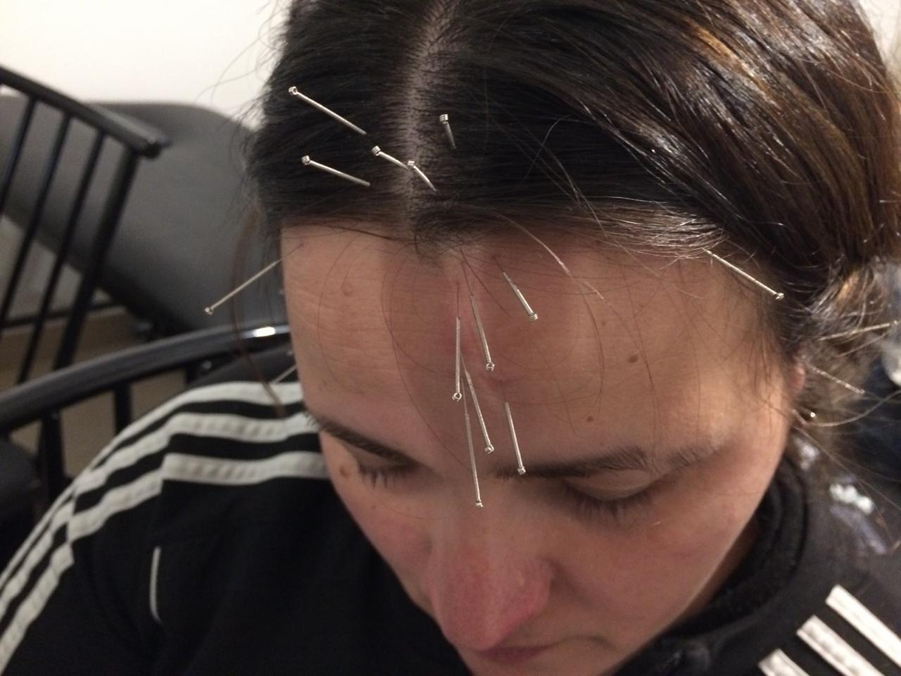 Acupuntura facial