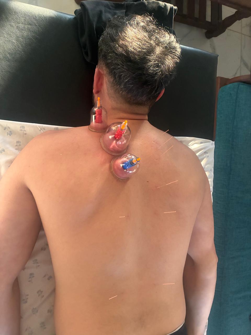 Acupuntura y ventosas en espalda