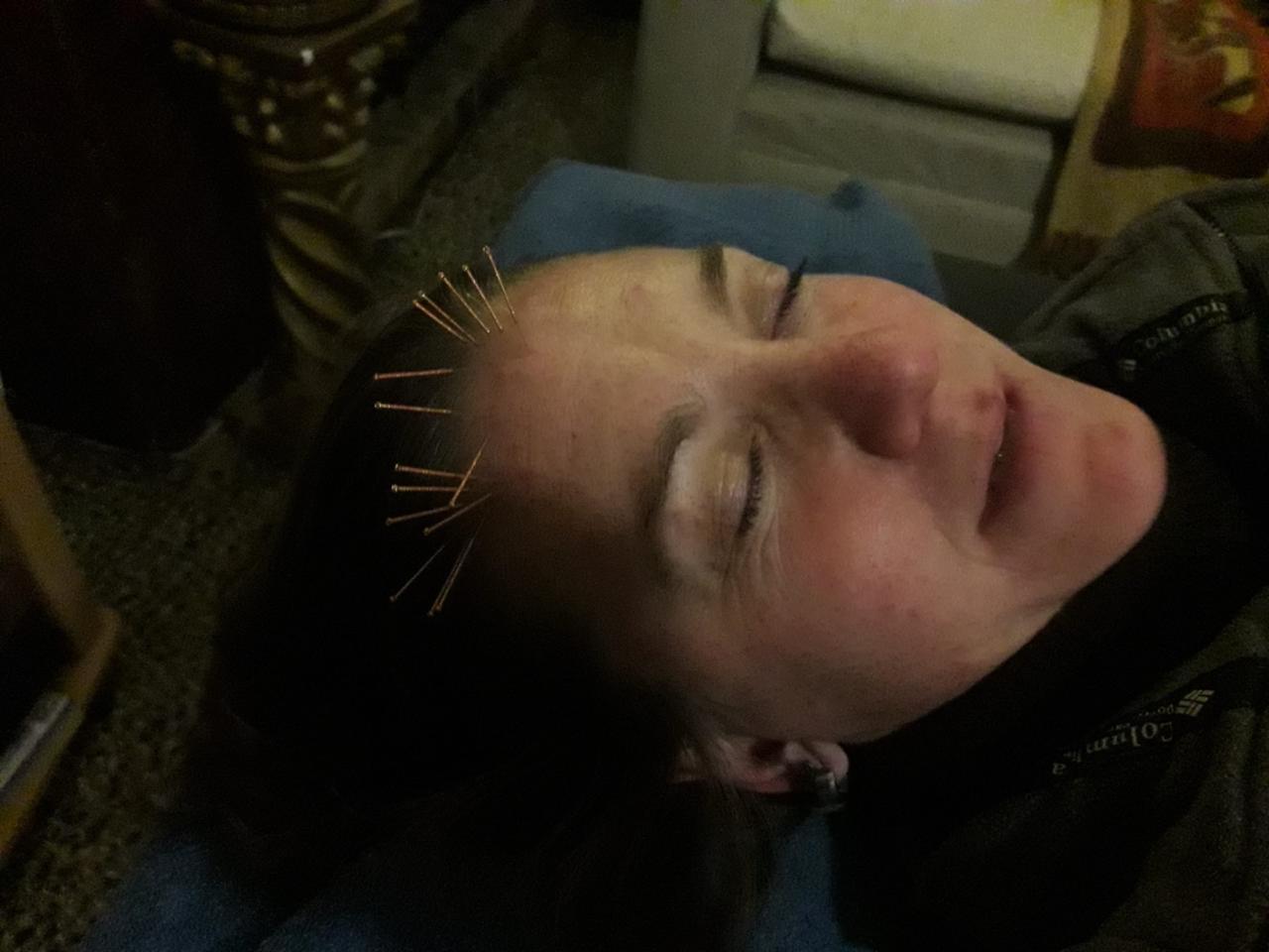 Acupuntura craneal